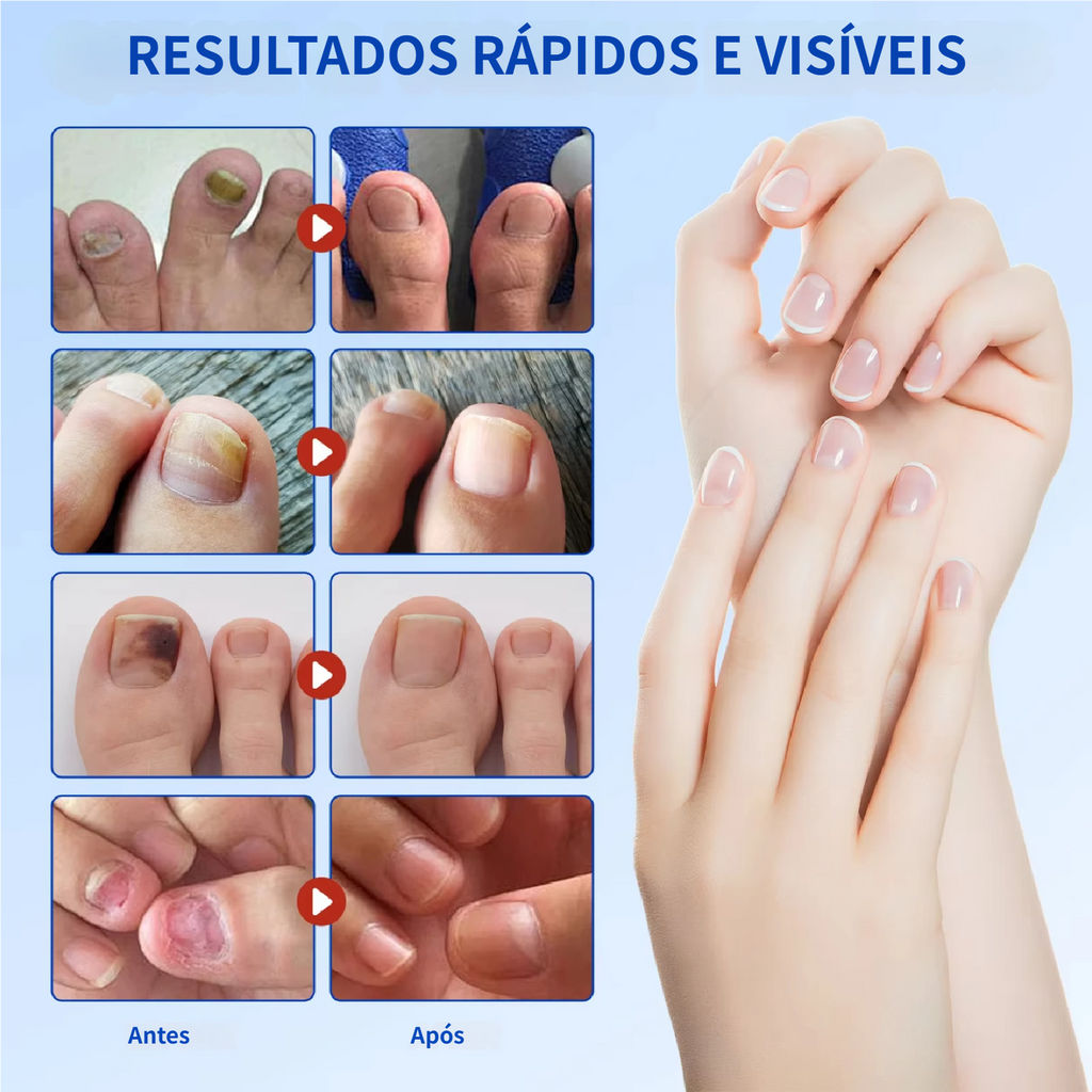 Reparação noturna de 8 horas para manchas de fungos nas unhas.