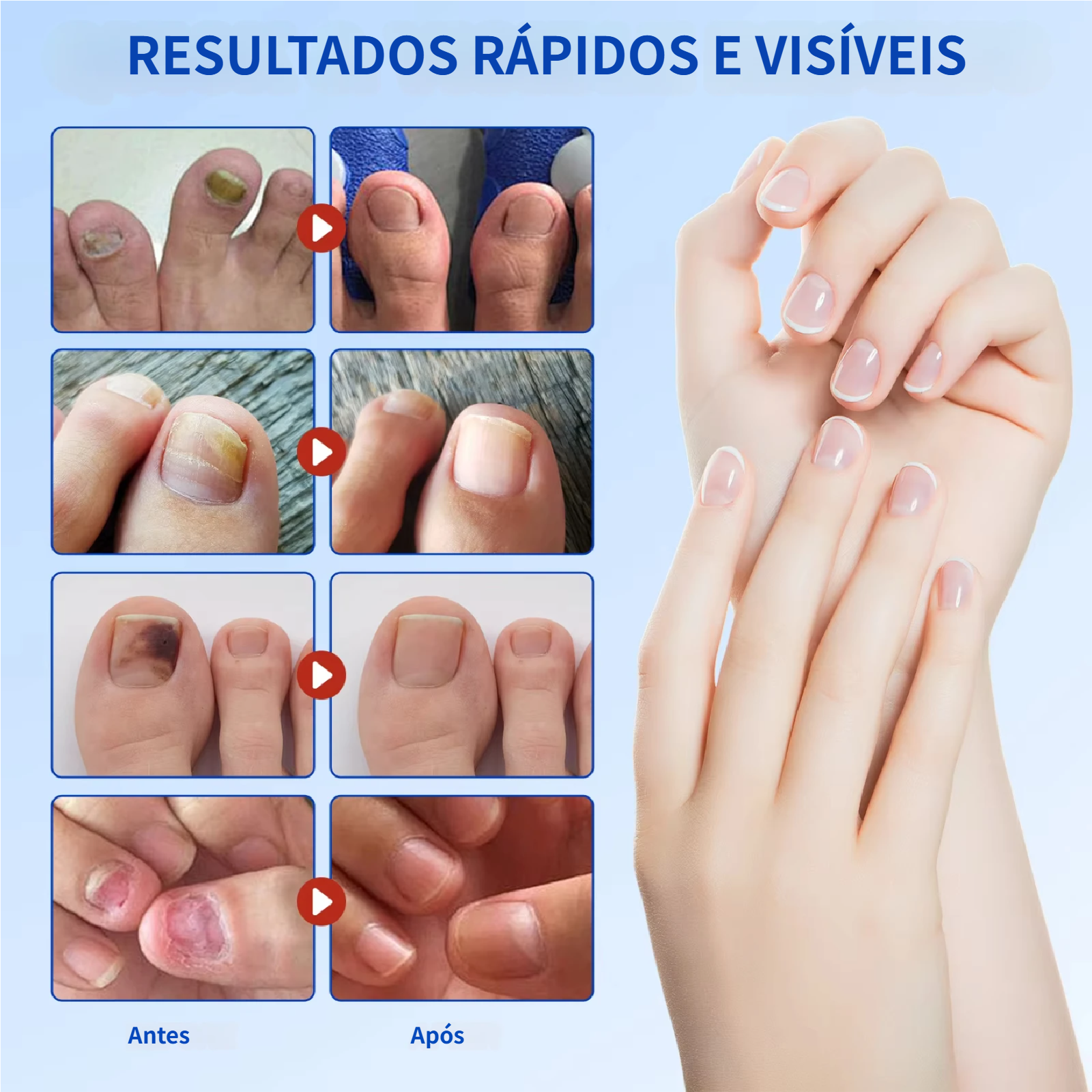 Reparação noturna de 8 horas para manchas de fungos nas unhas.